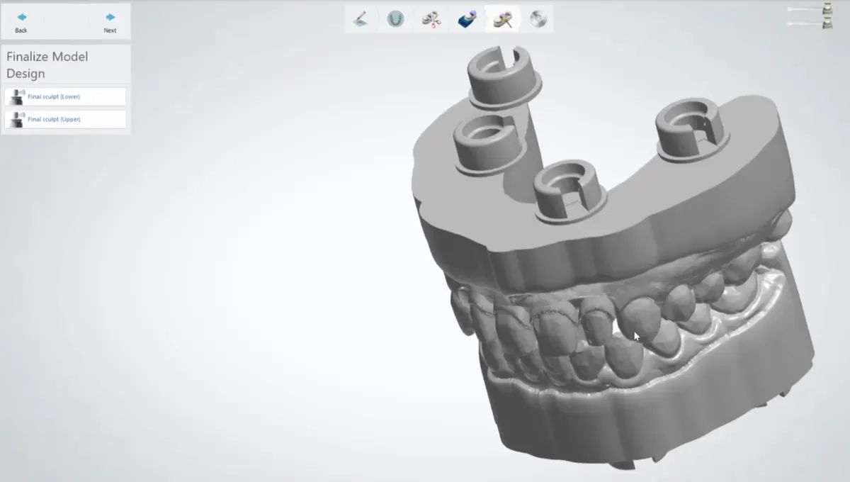 3Shape Model Builder : le modèle généré avec l’attachement DACOS à sa position