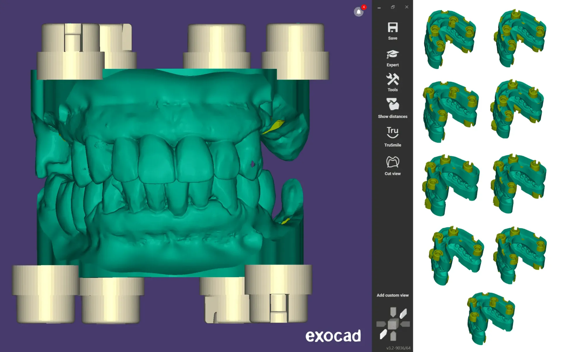 exocad with the DACOS library open: a full-arch model with its attachments, and the DockingMatrix™ combinations shown as thumbnails beside it