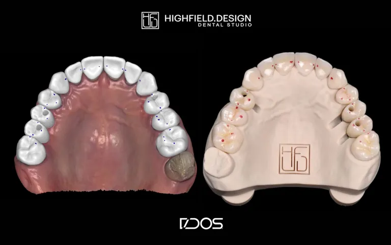 Case illustration: printed arches in occlusion on DACOS Omni
