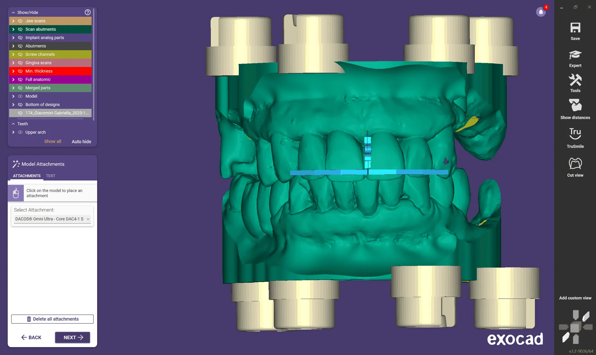 Attachements DACOS appliqués à un modèle dans exocad Model Creator