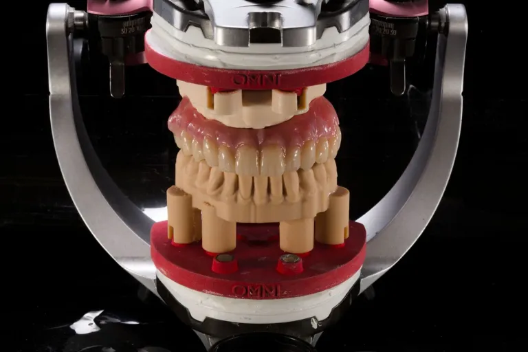Full arch prosthesis on red DACOS Omni plates