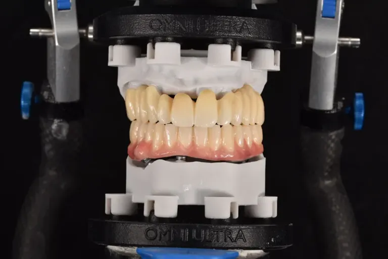 Full arch models on black DACOS Omni Ultra plates in the articulator