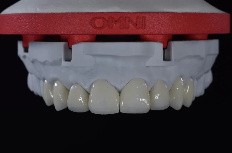 Ceramic crowns on a printed model mounted on a red DACOS Omni plate