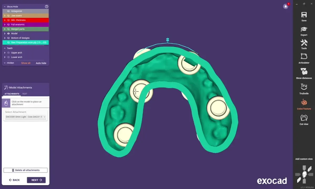 exocad Model Creator : les attachements DACOS placés dans la combinaison 4-5
