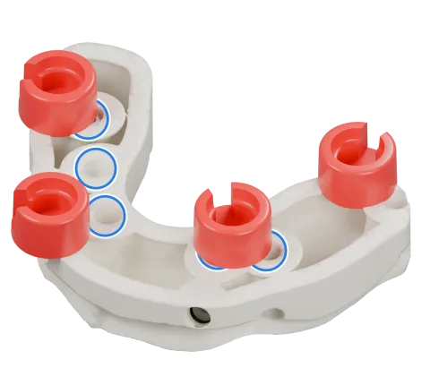 Rendu du même modèle sur implants avec les quatre logements DACOS rouges disposés en DAC4-1, positions 1 · 3 · 5 · 7, et des anneaux bleus sur les analogues d’implant.