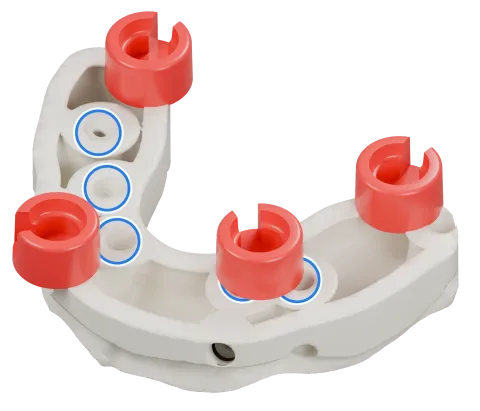 Rendu du même modèle sur implants avec les quatre logements DACOS rouges disposés en DAC4-2, positions 1 · 3 · 5 · 8, et des anneaux bleus sur les analogues d’implant.