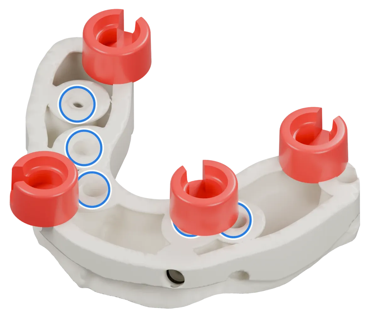 Rendu du même modèle sur implants avec les quatre logements DACOS rouges disposés en DAC4-2, positions 1 · 3 · 5 · 8, et des anneaux bleus sur les analogues d’implant.
