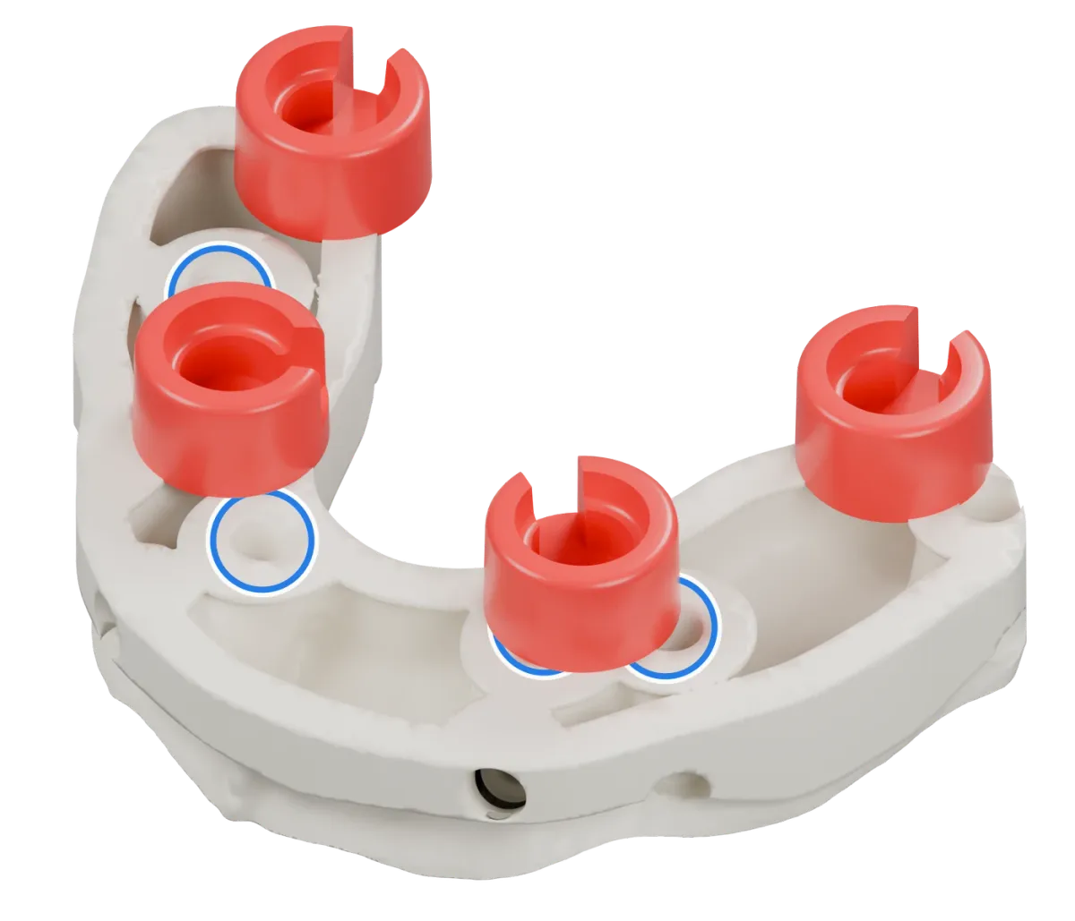 Rendu du même modèle sur implants avec les quatre logements DACOS rouges disposés en DAC4-3, positions 1 · 3 · 6 · 8, et des anneaux bleus sur les analogues d’implant.