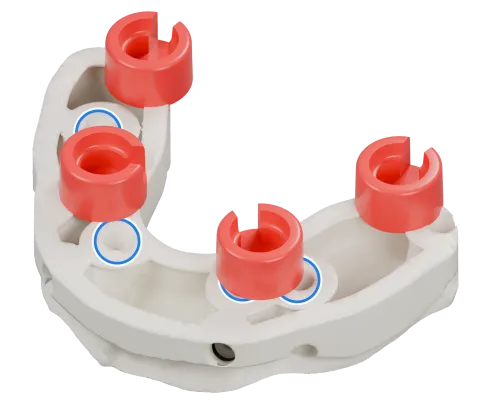 Rendu du même modèle sur implants avec les quatre logements DACOS rouges disposés en DAC4-3, positions 1 · 3 · 6 · 8, et des anneaux bleus sur les analogues d’implant.