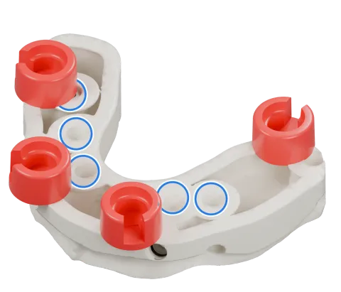 Rendu du même modèle sur implants avec les quatre logements DACOS rouges disposés en DAC4-4, positions 1 · 4 · 5 · 7, et des anneaux bleus sur les analogues d’implant.