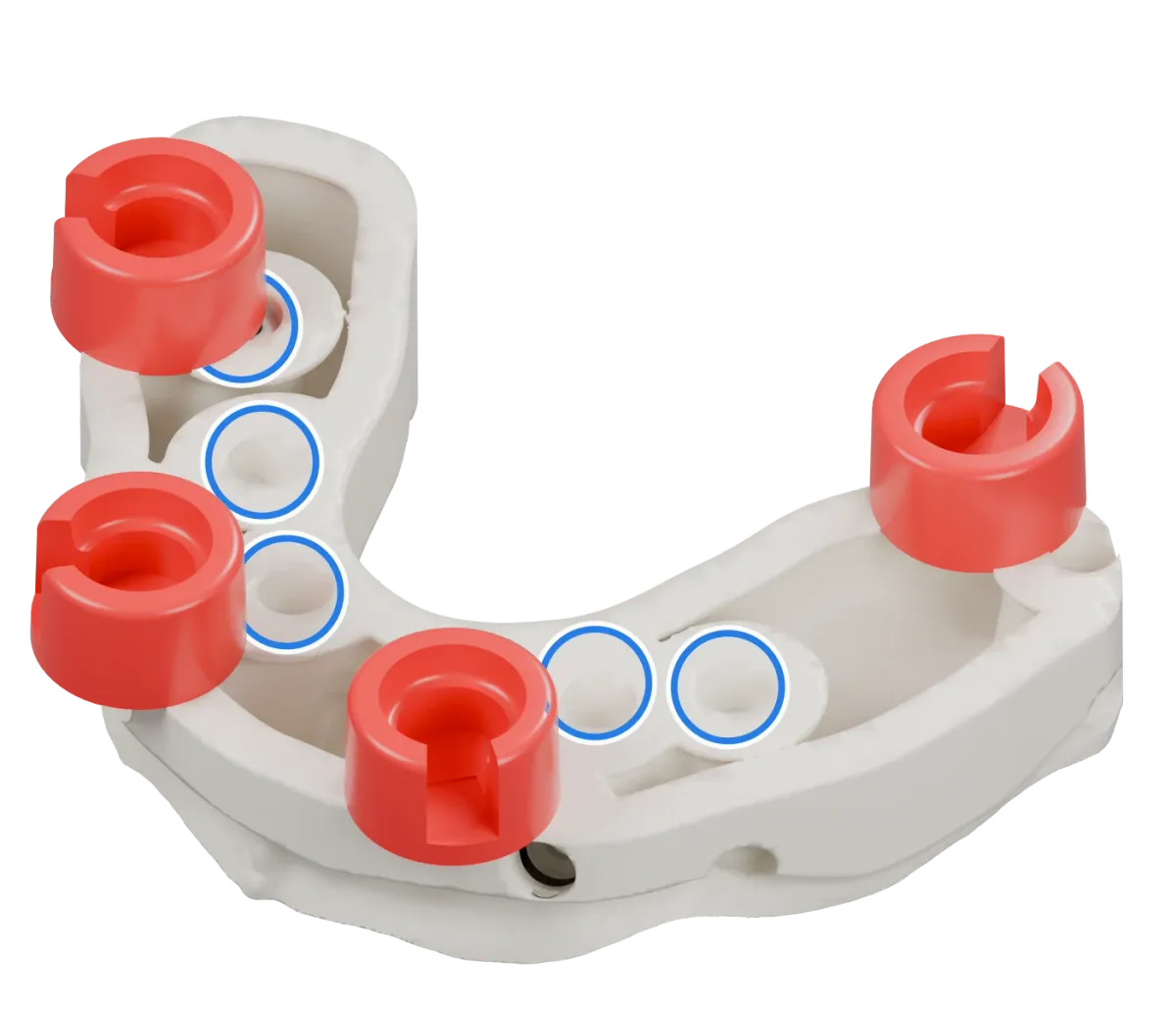 Rendu du même modèle sur implants avec les quatre logements DACOS rouges disposés en DAC4-4, positions 1 · 4 · 5 · 7, et des anneaux bleus sur les analogues d’implant.