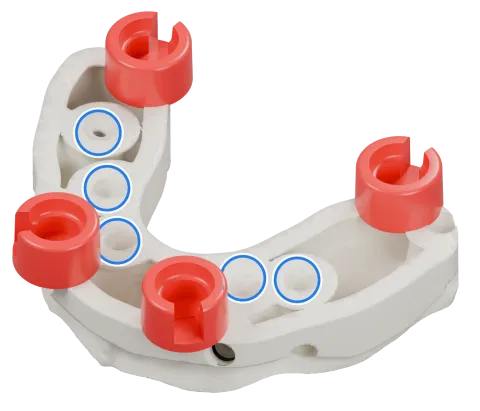 Rendu du même modèle sur implants avec les quatre logements DACOS rouges disposés en DAC4-5, positions 1 · 4 · 5 · 8, et des anneaux bleus sur les analogues d’implant.