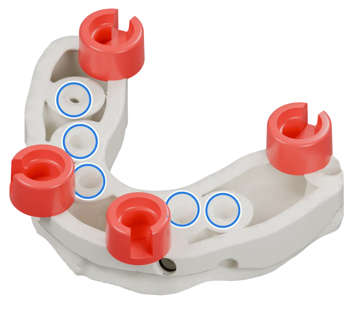 Rendu du même modèle sur implants avec les quatre logements DACOS rouges disposés en DAC4-5, positions 1 · 4 · 5 · 8, et des anneaux bleus sur les analogues d’implant.