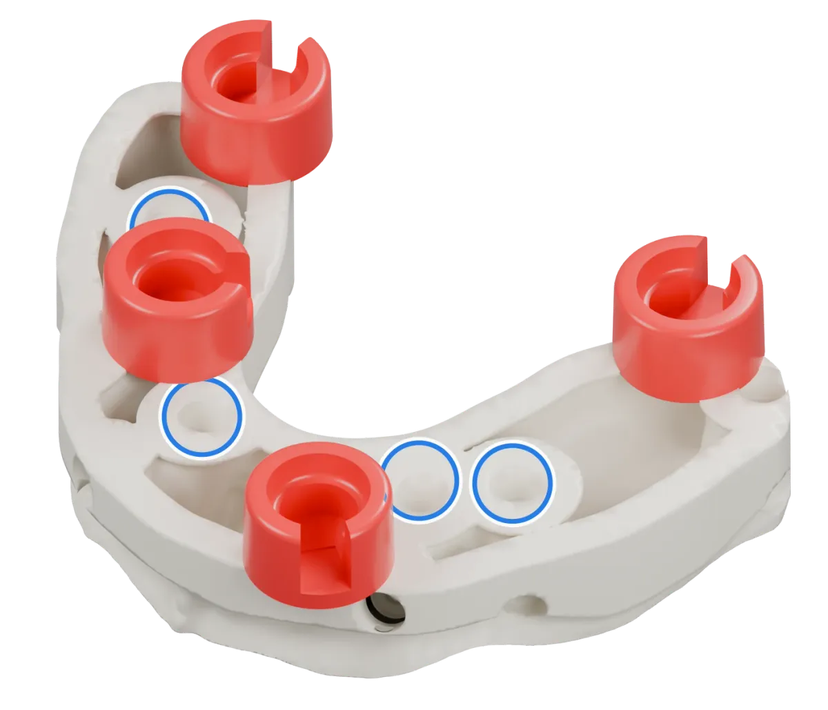 Rendu du même modèle sur implants avec les quatre logements DACOS rouges disposés en DAC4-6, positions 1 · 4 · 6 · 8, et des anneaux bleus sur les analogues d’implant.