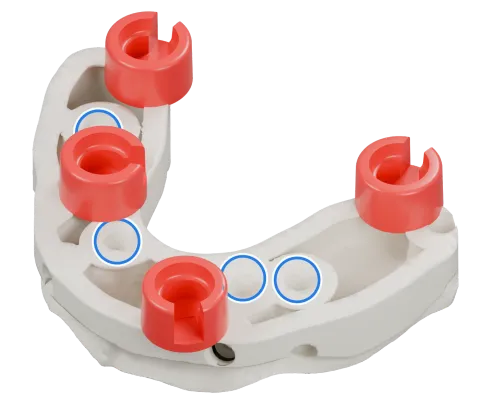 Rendu du même modèle sur implants avec les quatre logements DACOS rouges disposés en DAC4-6, positions 1 · 4 · 6 · 8, et des anneaux bleus sur les analogues d’implant.