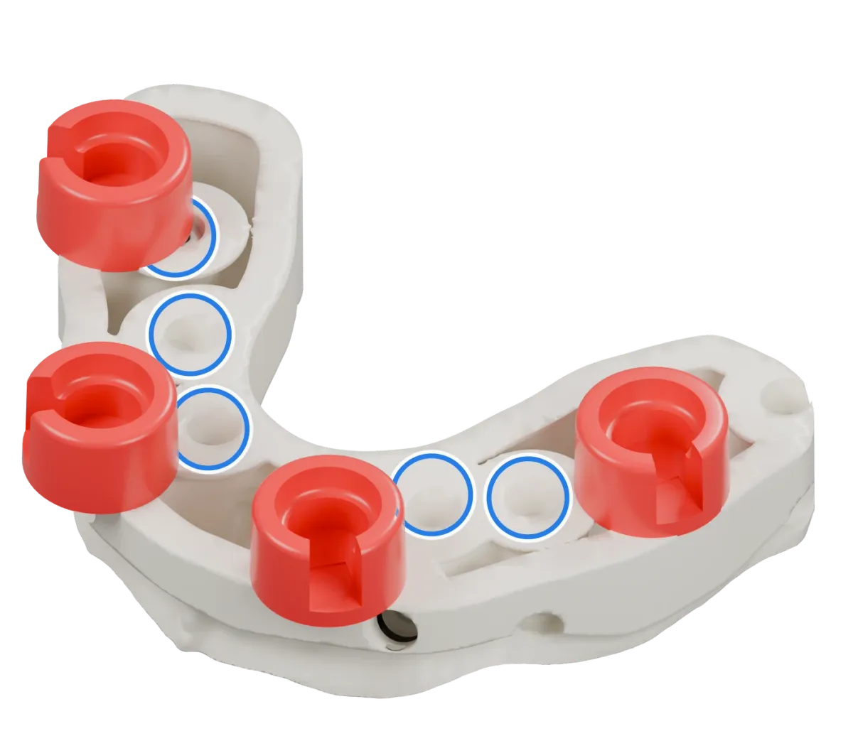 Rendu du même modèle sur implants avec les quatre logements DACOS rouges disposés en DAC4-7, positions 2 · 4 · 5 · 7, et des anneaux bleus sur les analogues d’implant.