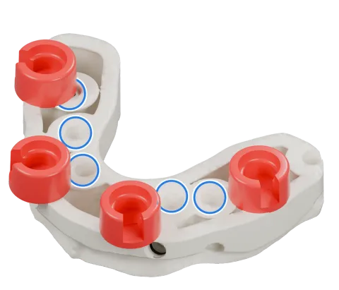 Rendu du même modèle sur implants avec les quatre logements DACOS rouges disposés en DAC4-7, positions 2 · 4 · 5 · 7, et des anneaux bleus sur les analogues d’implant.