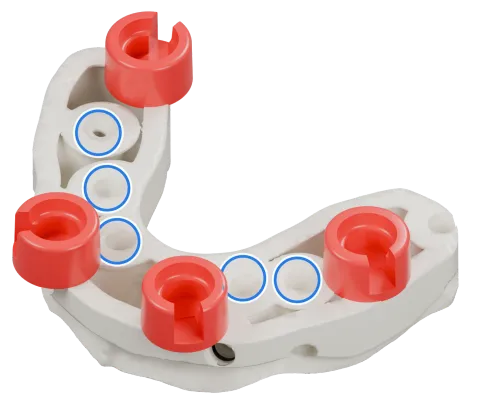 Rendu du même modèle sur implants avec les quatre logements DACOS rouges disposés en DAC4-8, positions 2 · 4 · 5 · 8, et des anneaux bleus sur les analogues d’implant.
