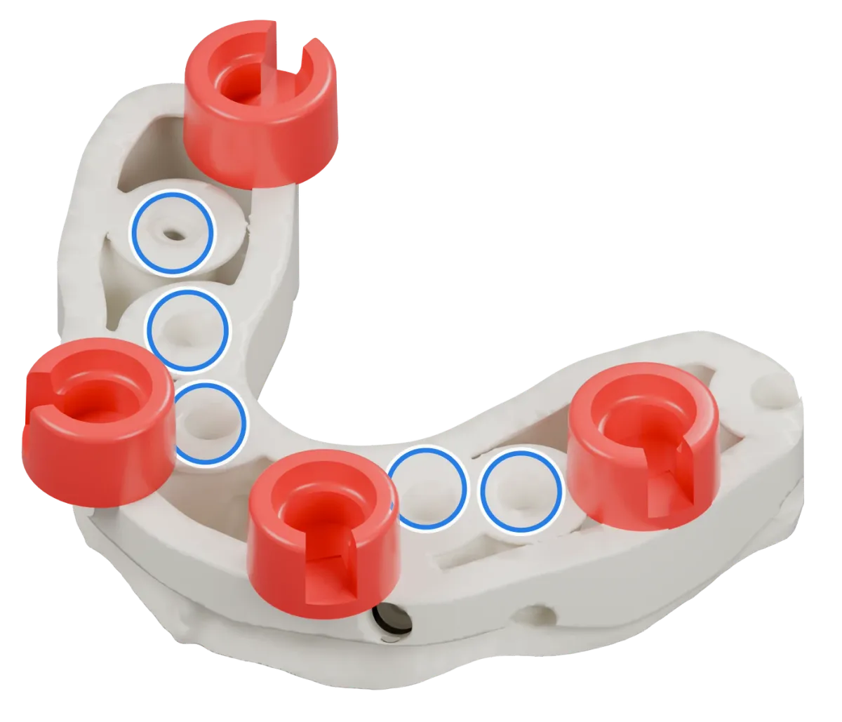 Rendu du même modèle sur implants avec les quatre logements DACOS rouges disposés en DAC4-8, positions 2 · 4 · 5 · 8, et des anneaux bleus sur les analogues d’implant.