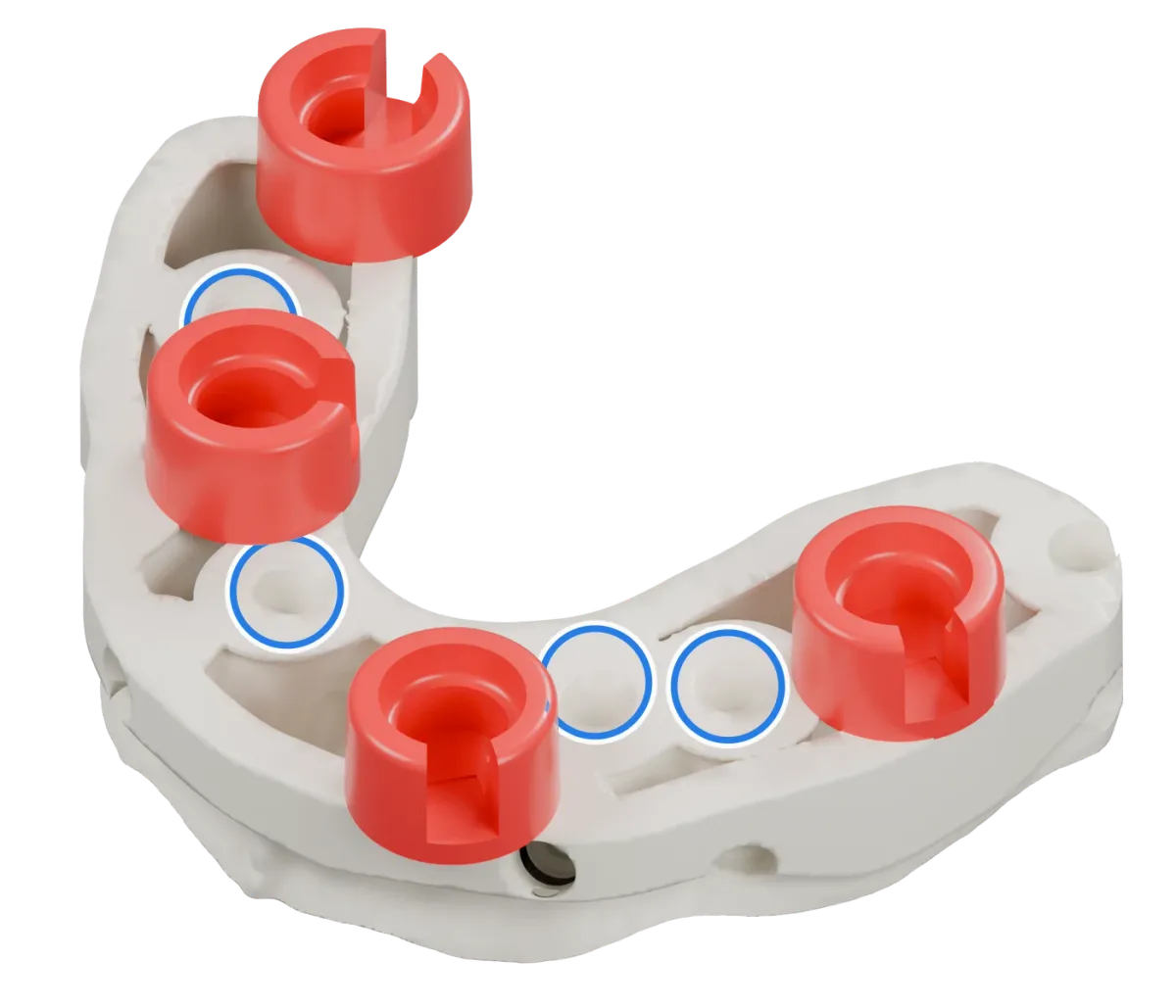 Rendu du même modèle sur implants avec les quatre logements DACOS rouges disposés en DAC4-9, positions 2 · 4 · 6 · 8, et des anneaux bleus sur les analogues d’implant.
