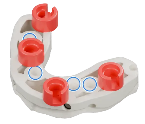 Rendu du même modèle sur implants avec les quatre logements DACOS rouges disposés en DAC4-9, positions 2 · 4 · 6 · 8, et des anneaux bleus sur les analogues d’implant.