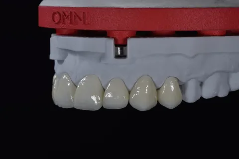Ceramic crowns on a printed model on a red DACOS Omni plate, second angle