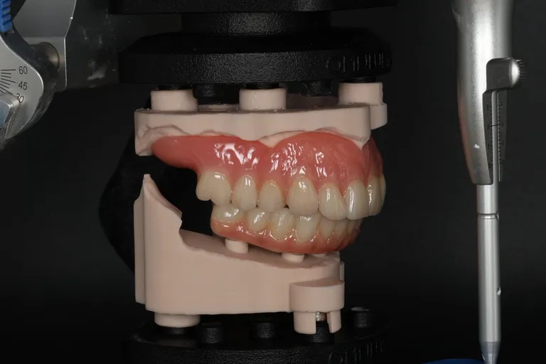 Implant full arch on DACOS Omni plates in the articulator