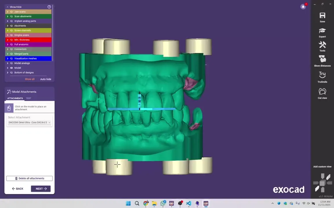 exocad Model Creator place les attachements DACOS Omni sur la conception d’un modèle à imprimer