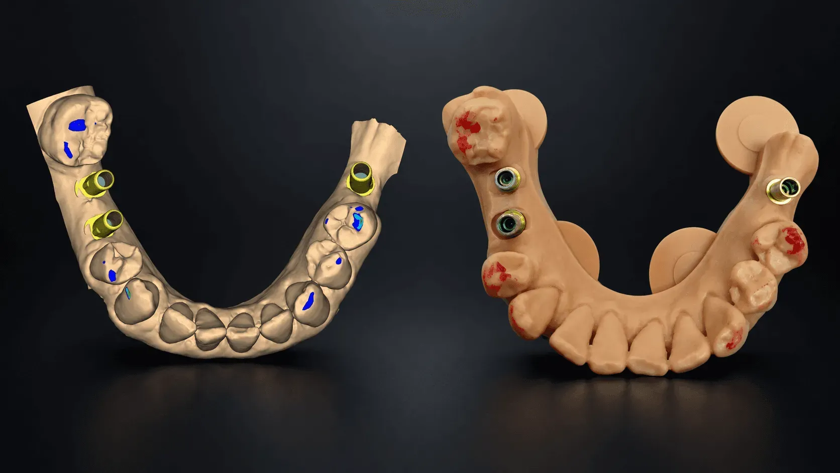A lower arch with implant analogs shown twice: the CAD design with its contact points marked in blue, and the printed model with analogs seated and articulating-paper marks in red